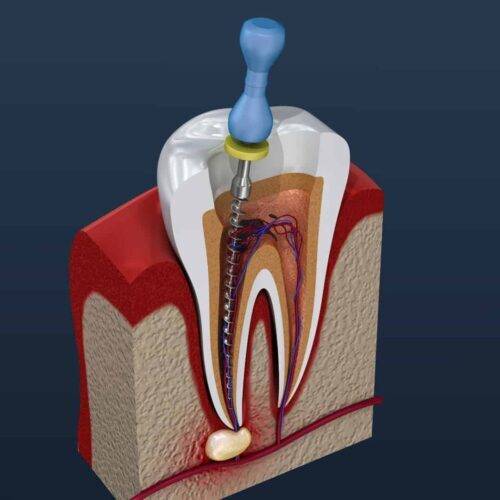 Beneficiile tratamentului endodontic