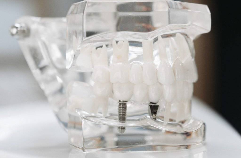 implant dentar pe model transparent