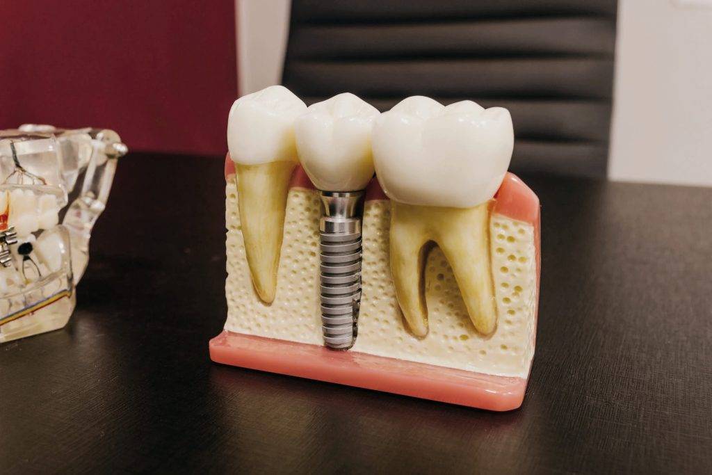 Cost implant dentar, durata si alte detalii pe care trebuie sa le afli inainte sa incepi tratamentul!