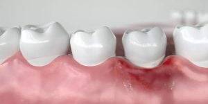 boala gingivala parodontologie