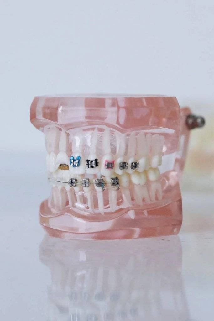 Aparatul dentar - Moft sau necesitate?